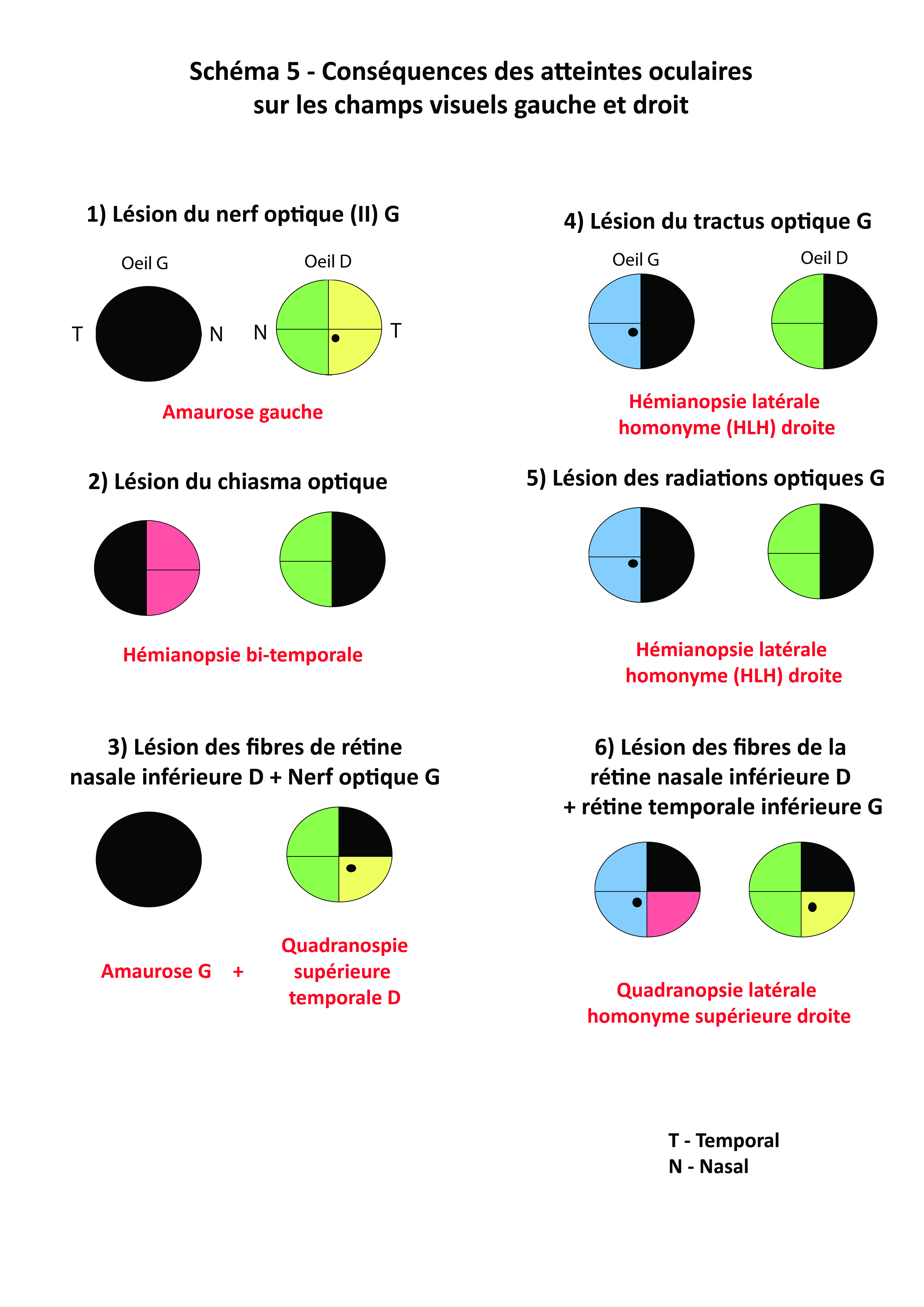 Schéma 5 - Conséquences des atteintes oculaires sur les champs viseuls gauche et droit def.jpg