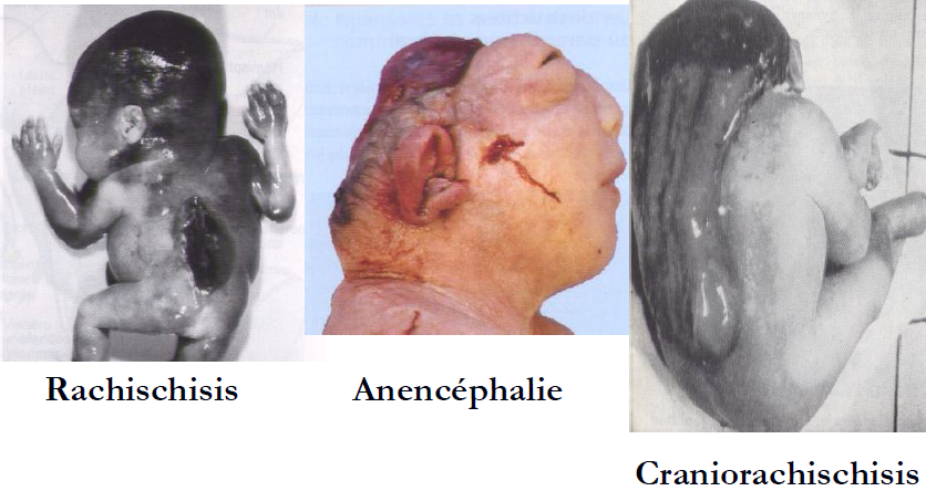 Anomalies fermeture gouttière neurale.png