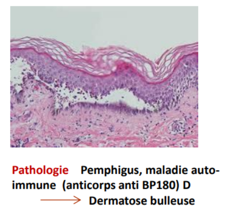 Dermatose bulleuse - HISTO.png