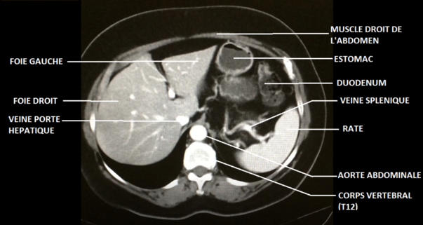 tomographie abdomen.png